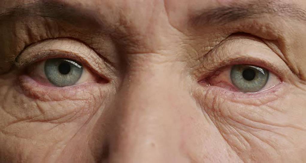 علائم و علل پیر چشمی